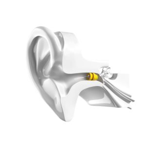Lyric invisible hearing aid
