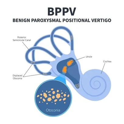 Benign Paroxysmal Positional Vertigo