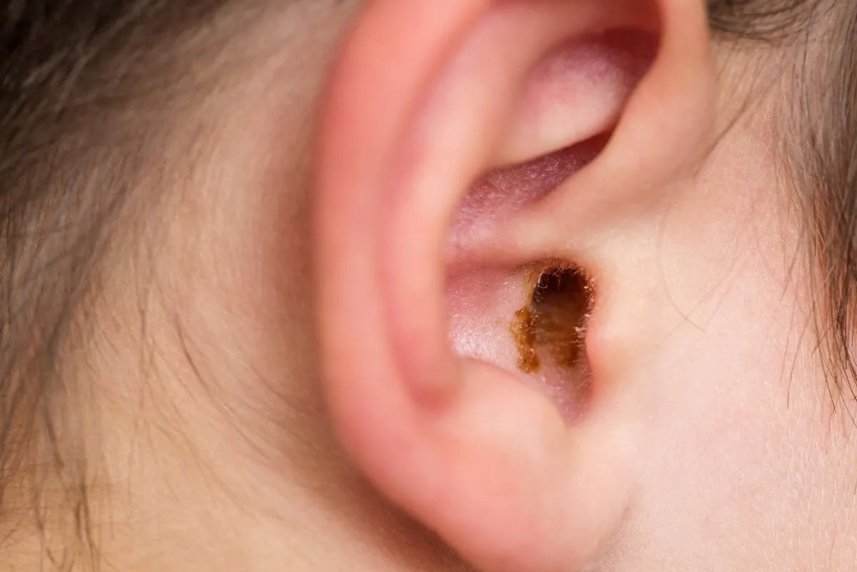 Earwax in the dirty ear of a child. Hole ear of human, wax on hair and skin of ear.